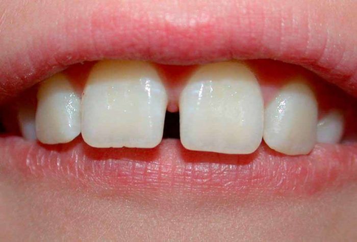 الفرق الموجود بين الأسنان الأمامية