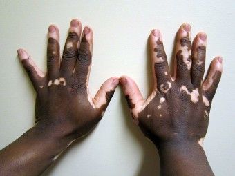علميًا كيف تحَّول لون بشرة مايكل جاكسون إلى الأبيض ؟