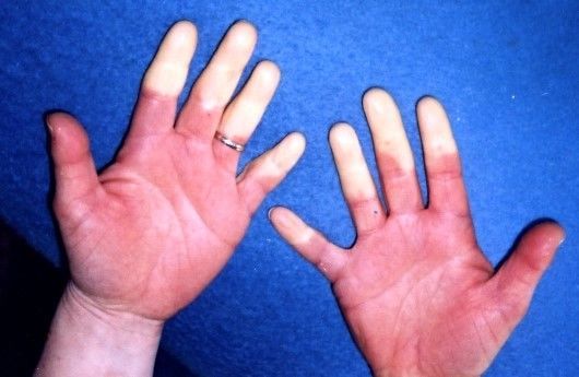 قد يكون هذا هو السبب وراء برودة يديك الدائمة مرض رينود برودة الأطراف حالة مرضية اليدين القدمين أصابع الأطراف الأنف والأذنين والحلمتين