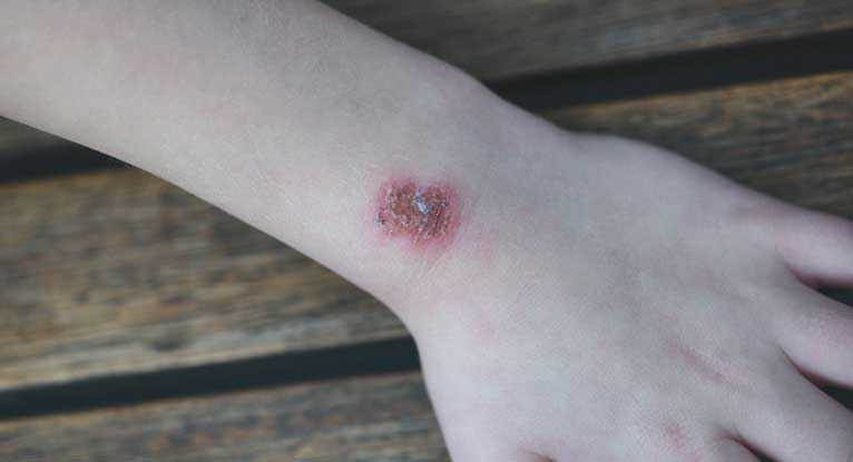 احذر من هذه الأمراض الجلدية التي تهدد حياتك مجموعة من الأمراض الجلدية الخطيرة التي من الممكن أن تهدد حياة صاحبها أمراض الجلد بثور