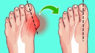 طرق سهلة لتقليص أورام القدمين بدون جراحة ما هي أنسب الطرق التي تساعد في التخلص من أورام القدمين علاج الأورام ارتداء أحذية غير مناسبة