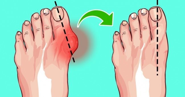 طرق سهلة لتقليص أورام القدمين بدون جراحة ما هي أنسب الطرق التي تساعد في التخلص من أورام القدمين علاج الأورام ارتداء أحذية غير مناسبة